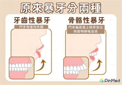 暴牙梗圖|你知道暴牙是有分類型的嗎？